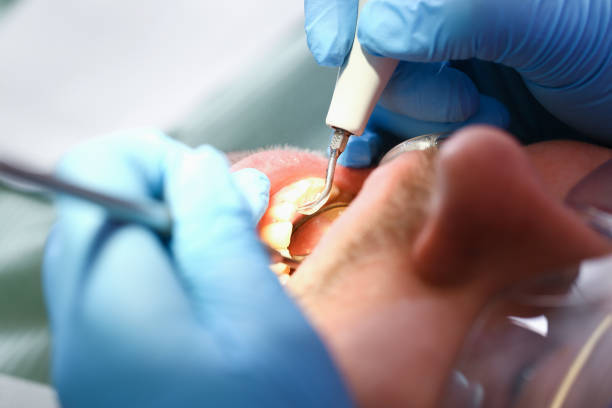 Best Emergency Dental Extractions in Mcswain, CA
